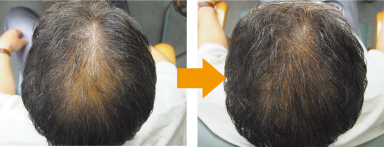 40代男性｜200本増毛
